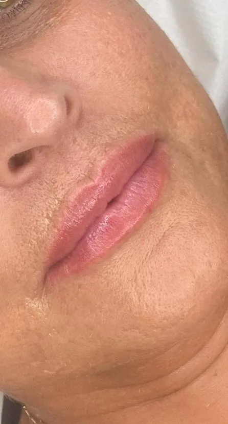 Risultato labbra naturale
